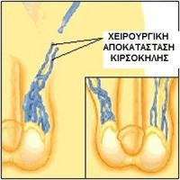 MyDoctors ΓΙΑΤΡΕ ΕΧΩ ΚΙΡΣΟΚΗΛΗ. ΤΙ ΕΙΝΑΙ; ΘΑ ΠΡΕΠΕΙ ΝΑ ΑΝΗΣΥΧΩ; 3 3