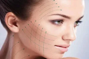 MyDoctors Face lift ή Νήματα; 10 MyDoctors l pdo threadlift 1