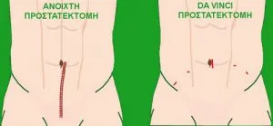 MyDoctors Ρομποτική Ριζική Προστατεκτομή 2 incisionsitesdvpgreen.jpg