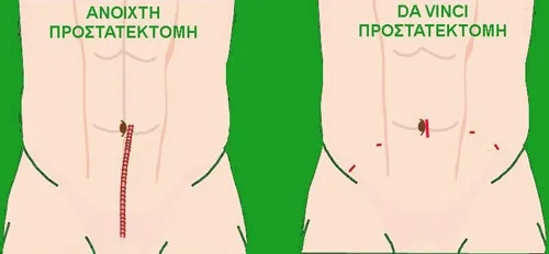 incisionsitesdvpgreen.jpg incisionsitesdvpgreen.jpg