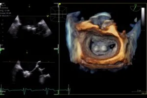 MyDoctors Διαδερμική επιδιόρθωση μιτροειδούς βαλβίδας 3 MyDoctors PAPADOPOULOS ET TEER