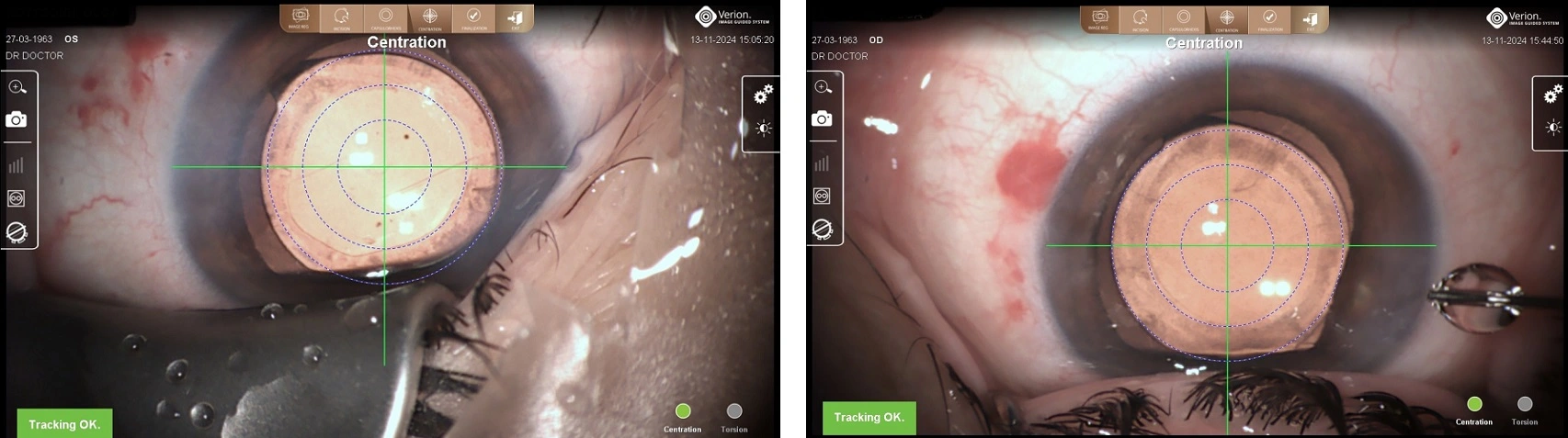 MyDoctors Όταν ο χρόνος θολώνει το φως και η επιστήμη το καθαρίζει ξανά 3 MyDoctors 3