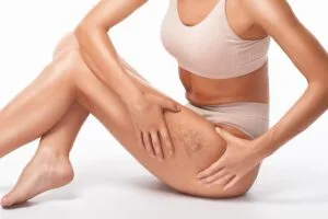 MyDoctors Σύγχρονη θεραπεία κιρσών και ευρυαγγειών 3 MyDoctors ANTONIADIS shutterstock 2292404427