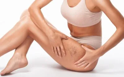 Σύγχρονη θεραπεία κιρσών και ευρυαγγειών