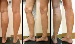 varicose-leg1.jpg