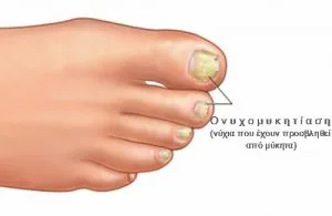 onicomicosi-500x325.jpg