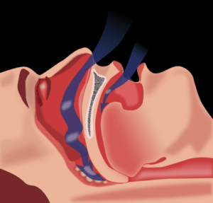 sleepapnea.png