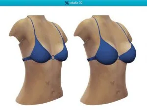 Subfascial