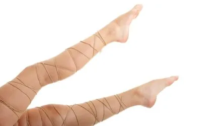 Κιρσοί των κάτω άκρων – Επέμβαση με Laser