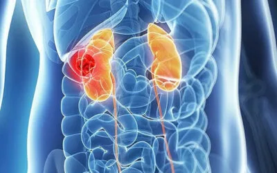 Καρκίνος του νεφρού: Θεραπεία με ελάχιστα επεμβατικές μεθόδους