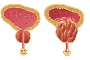 MyDoctors normal enlarged prostate 980x614 1
