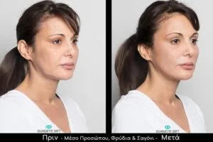 MyDoctors Triantafillidis ikonDerma Silhouette Soft Pack11