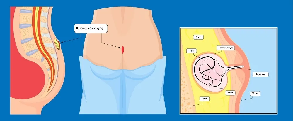 MyDoctors Koronaios kysthkokkyga