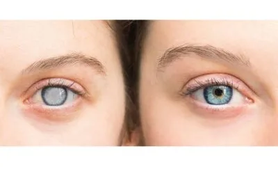 Καταρράκτης: Μία πολύ κοινή πάθηση του ματιού που δεν πρέπει να μας φοβίζει