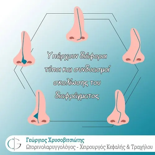 MyDoctors XRISOVITSIOTIS 2 Τυποι σκολιωσης