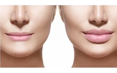 Lip Lift: Η μικροεπέμβαση που αναβαθμίζει το πρόσωπο