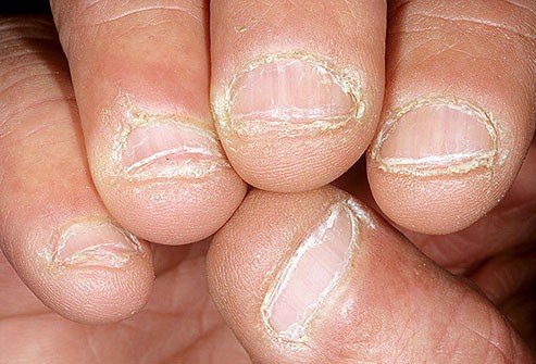 dermnet_photo_of_bitten_nails.jpg
