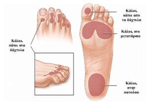 MyDoctors Ειδικοί Ποδίατροι του Κέντρου Ποδιού μας δίνουν συμβουλές για κάλους και σκληρύνσεις. 14 tmp445.png