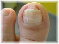 Ποδολογία,Ποδιατρική,Ποδολόγος,Ποδίατρος,Podology,Podiatry,θεραπεία κάλλων, κάλλοι,πόδι