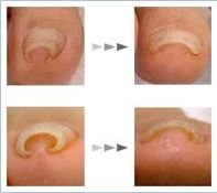 Ποδολογία,Ποδιατρική,Ποδολόγος,Ποδίατρος,Podology,Podiatry,θεραπεία κάλλων, κάλλοι,πόδι