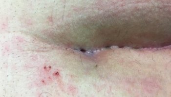 Ενδοσκοπική μέθοδος κύστης κόκκυγα (Epsit)