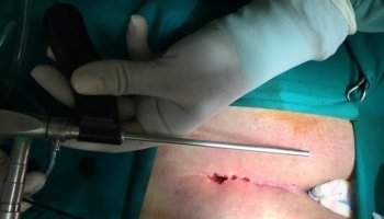 Ενδοσκοπική μέθοδος κύστης κόκκυγα (Epsit)