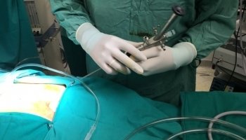 Ενδοσκοπική μέθοδος κύστης κόκκυγα (Epsit)