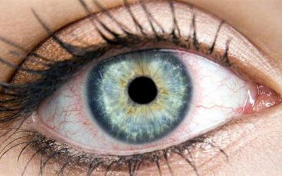 Μάτια: 10 συμβουλές για να προστατευθείτε από την εαρινή επιπεφυκίτιδα