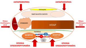 MyDoctors Οπισθοπεριτοναϊκή Χειρουργική Νεφρού - Μερική Νεφρεκτομή 3 MyDoctors nefrektomi.2