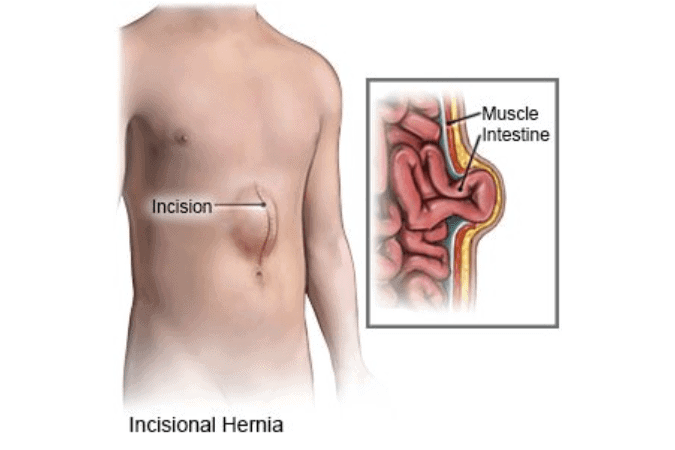μετεγχειρητική κήλη