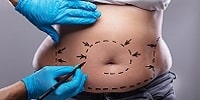 MyDoctors ΠΑΘΗΣΕΙΣ 78 MyDoctors koilioplastiki tag min