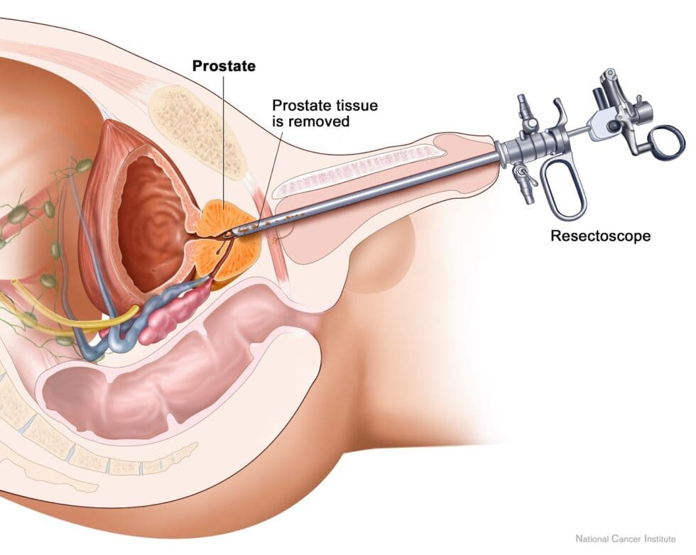 MyDoctors transurethral prostatectomy 980x782 1