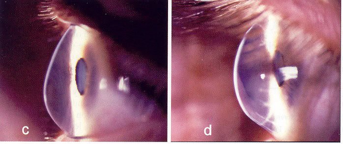 MyDoctors Κερατόκωνος. Η οφθαλμική πάθηση που «φλερτάρει» με τα νεαρά άτομα 1 MyDoctors Miltsakakis keimenou 1