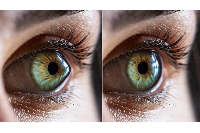 Macro,Before,And,After,Surgery,Of,A,Clear,Female,Eye