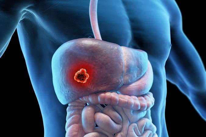 3d,Rendered,Medical,Illustration,Of,Male,Anatomy,-,Liver,Cancer.
