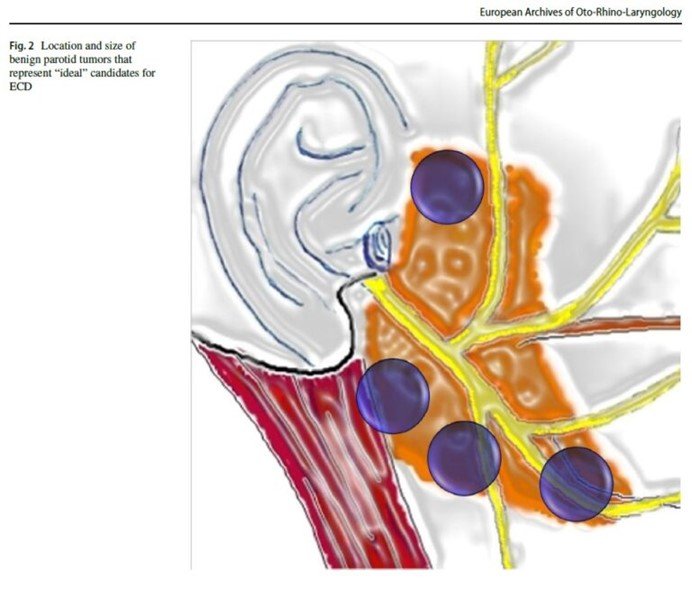 MyDoctors παρωτιδεκτομη3